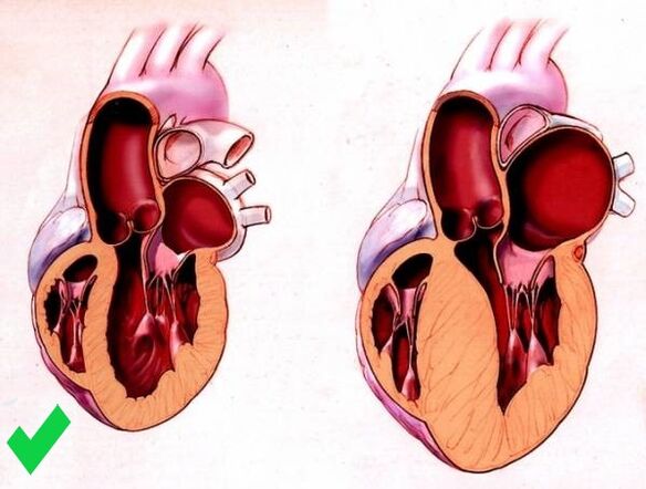 Cardione спречава вентрикуларну хипертрофију срца